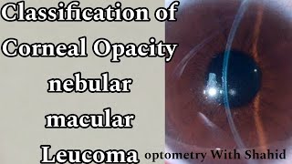 Classification Of Corneal Opacity  Nebular macular Leucoma  Optometry with Shahid [upl. by Viafore821]