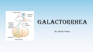 Causes amp pathophysiology of galactorrhea prolactinoma pituitary stalk compression hypothyroidism [upl. by Austin]