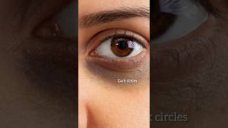 Dark circles treatment  skincare darkcircles youtubeshorts shorts [upl. by Ollopa]