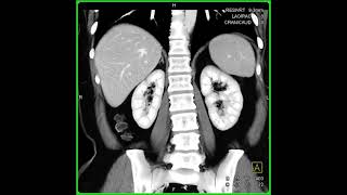 Carcinoid Tumor Duodenum [upl. by Eudora]