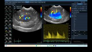 IQ 279 LIVER ULTRASOUND HEPATOMA ECHOPAC ANALYSIS ECHOCARDIOGRAPHY DOPPLER MODE [upl. by Kan]