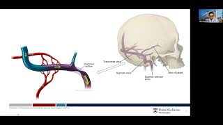 Etiology of Idiopathic Intracranial Hypertension IIH [upl. by Kyl]