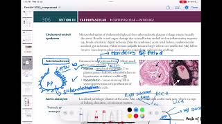 Arteriosclerosis cardiology 70  First Aid USMLE Step 1 in UrduHindi [upl. by Ingles]