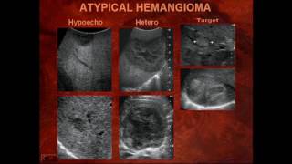 Sonography of Liver Masses [upl. by Adiarf]