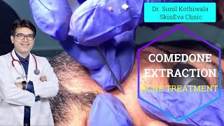 Comedone Extraction Procedure Video  Dermatologist  Comedone Extraction in Jaipur [upl. by Antoinetta567]