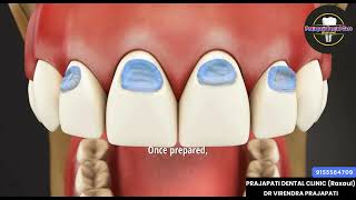 Composite filling in Abfraction tooth [upl. by Liatris]