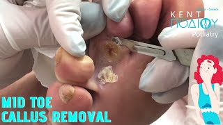 Mid toe callus removalΑφαίρεση μεσοδακτύλιου κάλουΚέντρο Ποδιού PodiatryPodiatristΠοδιατρική [upl. by Ruthanne]