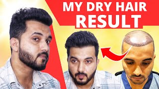 My Hair Transplant Result In Dry Condition [upl. by Nnylirej277]