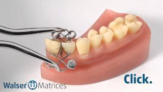 Walser® Sectional Matrix system Application XFform dental matrix [upl. by Zsuedat]