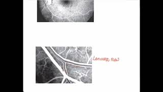 Normal Fluorescein AngiogramOphthalmology [upl. by Perot746]