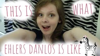 This Is What Ehlers Danlos Syndrome Is Like [upl. by Handler]