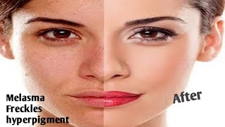 NUVEL CreamMelasma CreamFrecklesDark ComplexionUneven skinin Urdu in Hindi [upl. by Siroled]