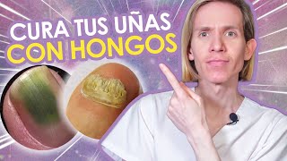 COMO CURAR LOS HONGOS EN LAS UÑAS  Guía para resolver Onicomicosis de manos y pies  Simon Scarano [upl. by Adnole851]