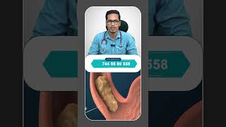 Gastroesophageal Reflux Disease In Tamil GERD shortsfeed trending viralvideo [upl. by Lenz]