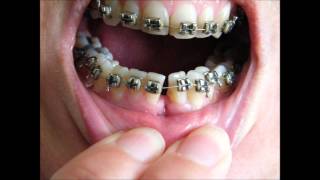 Bracesretainersbrackets  before and after timelapse 36 yr old [upl. by Essile]