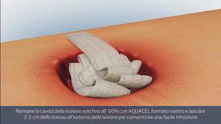 ConvaTec  AVELLE™ Sistema di terapia a pressione negativa Lesioni Profonde [upl. by Crosby]