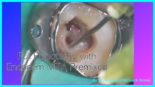 Full pulpotomy as a vital pulp therapy on permanent tooth with Endocem MTA premixed [upl. by Etneciv939]