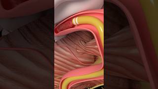 Mechanical Thrombectomy in stroke medicine anatomy science health stroke [upl. by Ingra]