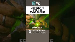 Laser Therapy for Nevus of OTA Removal Treatment  Nevus of OTA Treatment in Delhi  Dr PK Talwar [upl. by Anitnerolf]