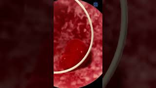 Hysteroscopy polyp removal  womenshealth hysteroscopicmyomectomy uterus drneerajpahlajani [upl. by Ative]