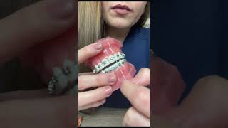 Que HILO DENTAL usar con BRACKETS 🦷 shortvideo shorts tipsdentales [upl. by Reisch]