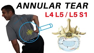 Annular Tear L4L5 L5S1 Disc Bulges [upl. by Halladba]