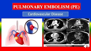 PULMONARY EMBOLISM PE  Definition types causes pathophysiology signs amp symptoms medicine [upl. by Ayekim81]