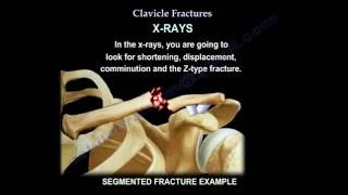 Clavicle Fractures  Everything You Need To Know  Dr Nabil Ebraheim [upl. by Losse]