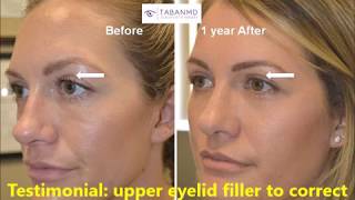 Upper Eyelid Filler injection to correct hollowness after upper blepharoplasty [upl. by Begga]