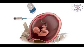 Genetic disorder diagnosis in pregnancy by Amniocentesis amp CVS Chorionic Villus Sampling [upl. by Colwin]