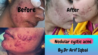 How to treat painful nodular acne  Steroid injection for cystic acne [upl. by Akehsat]