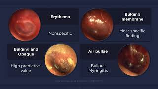 Acute Otitis Media Otoscopic Findings [upl. by Spillar]