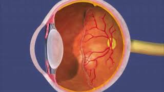 Animation Retinopathy of Prematurity [upl. by Avrit]