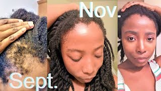 Grow Your Edges Super Fast  Bald  Thinning Edges Regimen  Routine  Natural Hair Growth Tips [upl. by Nnylesor663]