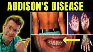 Doctor explains Addisons disease Adrenal insufficiency definition symptoms treatment amp more [upl. by Novahs]