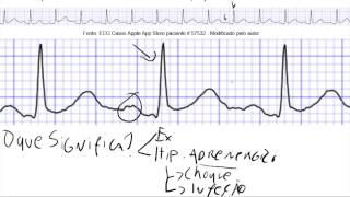 Descomplicando o ECG  Aula 10  Arritmia sinusal taquicardia sinusal bradicardia sinusal [upl. by Perseus]