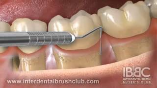 Periodontal disease causes and treatment [upl. by Celine91]