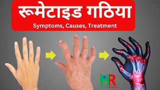 Rheumatoid arthritis information in hindi  rheumatoid arthritis signs causes treatment [upl. by Grigson]