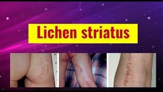 Lichen striatus overview causes features histology and management [upl. by Aldora]