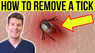 Doctor explains HOW TO REMOVE A TICK  Stepbystep guide [upl. by Aivun]