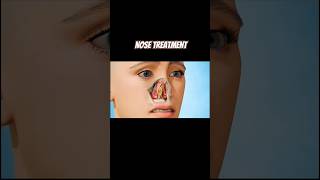 3D animation nose treatment explanation shorts 3danimation [upl. by Elaval]