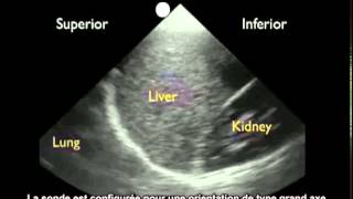 Comment  Détecter un épanchement pleural à laide dune échographie [upl. by Sedlik]