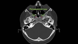 5🌺 An anatomical reminder🌺Foramen Rotundum and Pterygopalatine Fossa🎯Axial CT anatomy [upl. by Loralyn137]