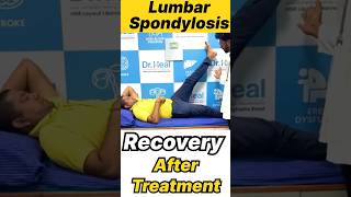 Lumbar Spondylosis Recovery After Treatment yt ytshorts ytshortsindia india kgf [upl. by Stratton481]