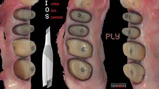 BOPT amp Intra Oral Scanner [upl. by Atinnor156]