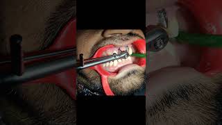 Dental Implant procedure dentist indiandentist dentistry [upl. by Auof258]