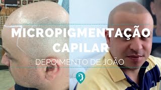 1 ano após a Micropigmentação Capilar  Depoimento de João [upl. by Ainek]