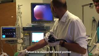 Midgastric functional stenosis after sleeve 30 mm Rigiflex dilatation By Dr Yerdel [upl. by Filberto]