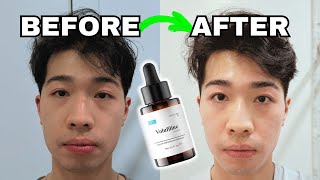 I used Volufiline for 150 Days on my Dark Circles  Does it WORK [upl. by Illib]