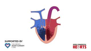 Tetralogy of Fallot [upl. by Lilia926]